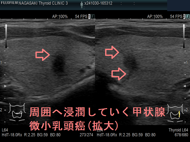 石灰化の無い甲状腺微小乳頭癌(拡大) 超音波(エコー)画像 周囲へ浸潤していく甲状腺微小乳頭癌(拡大)