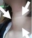 単純性甲状腺腫 単純性甲状腺腫
