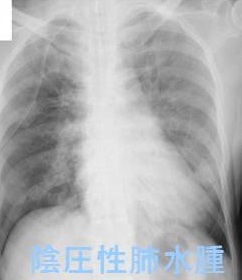 陰圧性肺水腫 胸Xp 陰圧性肺水腫 胸Xp