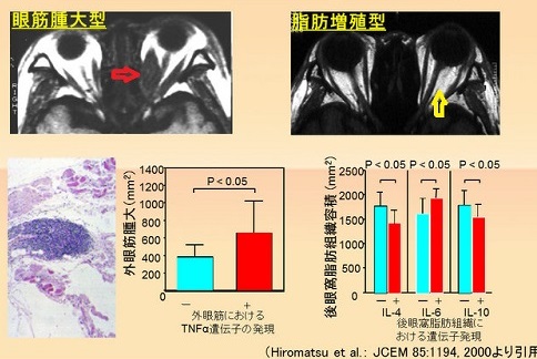 甲状腺眼症のMRI病型 甲状腺眼症のMRI病型