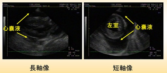 甲状腺機能低下による心嚢液貯留 甲状腺機能低下による心嚢液貯留