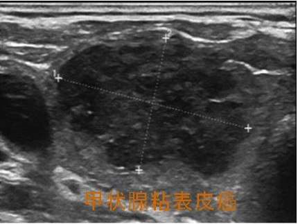 甲状腺粘表皮癌 超音波エコー画像 甲状腺粘表皮癌 超音波エコー画像