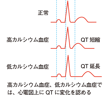 高カルシウム血症・低カルシウム血症の心電図 高カルシウム血症・低カルシウム血症の心電図