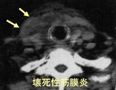 壊死性筋膜炎 CT画像 壊死性筋膜炎 CT画像