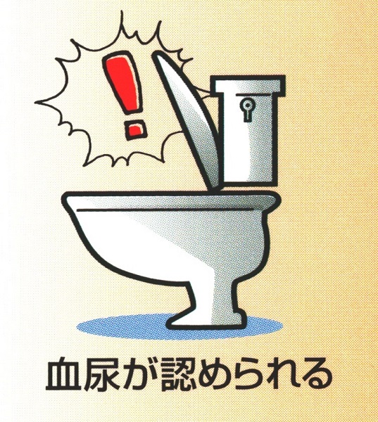 ANCA関連血管炎 血尿 ANCA関連血管炎 血尿