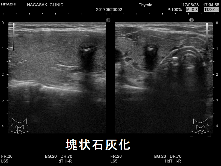 塊状石灰化 超音波(エコー)画像 塊状石灰化 超音波(エコー)画像
