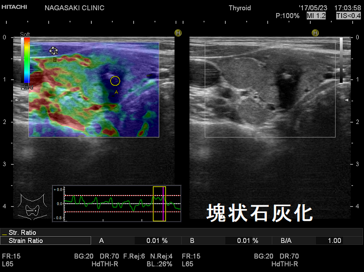 塊状石灰化 超音波(エコー)画像(エラストグラフィー) 塊状石灰化 超音波(エコー)画像(エラストグラフィー)