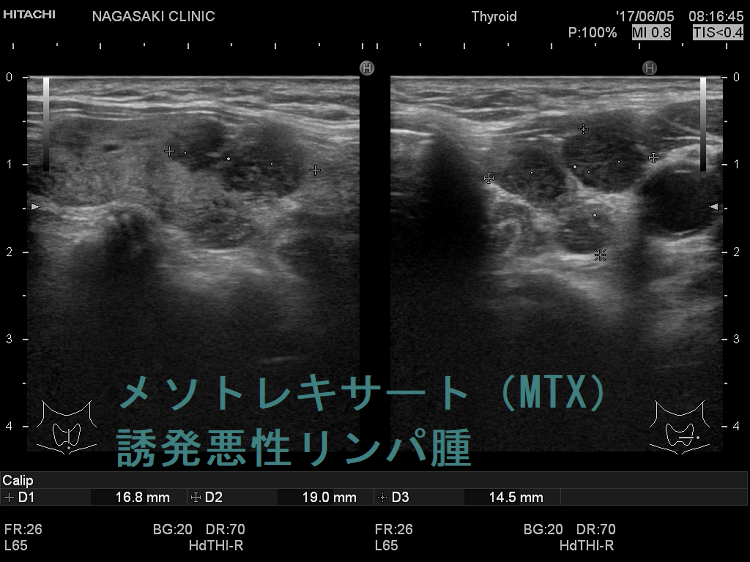メソトレキサート(MTX)誘発悪性リンパ腫 超音波(エコー)画像 メソトレキセート(MTX)誘発悪性リンパ腫 超音波(エコー)画像