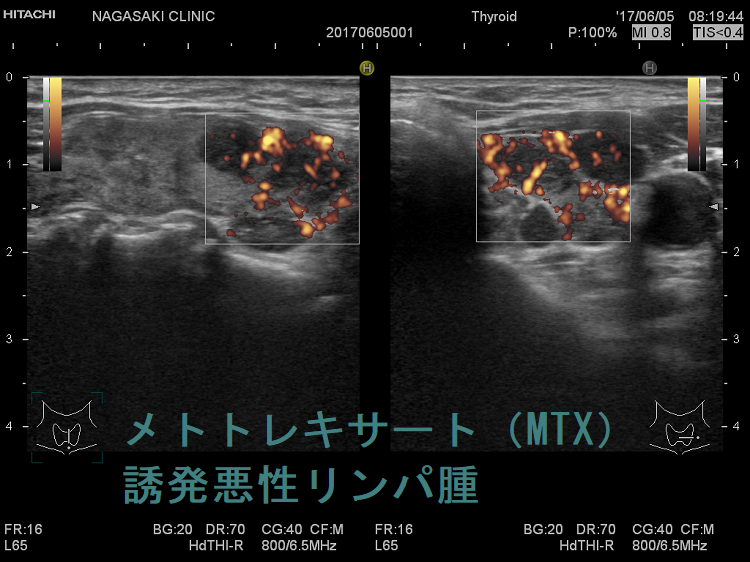 メトトレキサート(MTX)誘発悪性リンパ腫 超音波(エコー)画像 ドプラー メトトレキサート(MTX)誘発悪性リンパ腫 超音波(エコー)画像 ドプラー