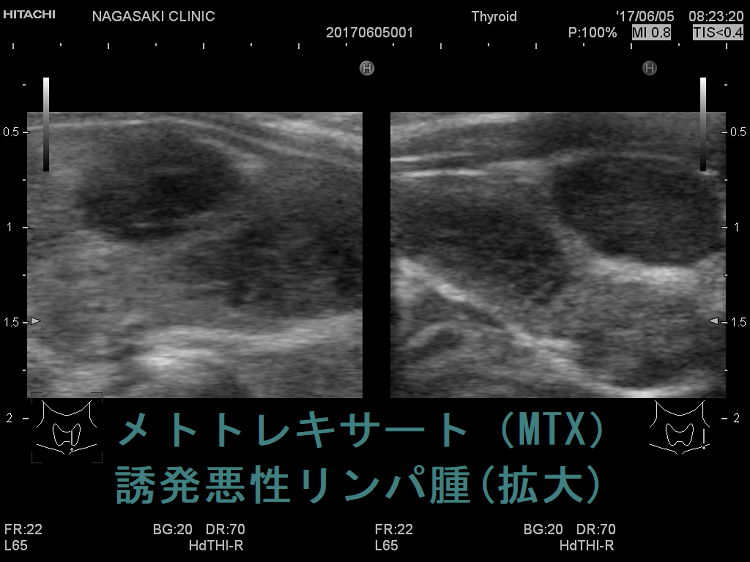 メトトレキサート(MTX)誘発悪性リンパ腫 超音波(エコー)画像(拡大) メトトレキサート(MTX)誘発悪性リンパ腫 超音波(エコー)画像(拡大)