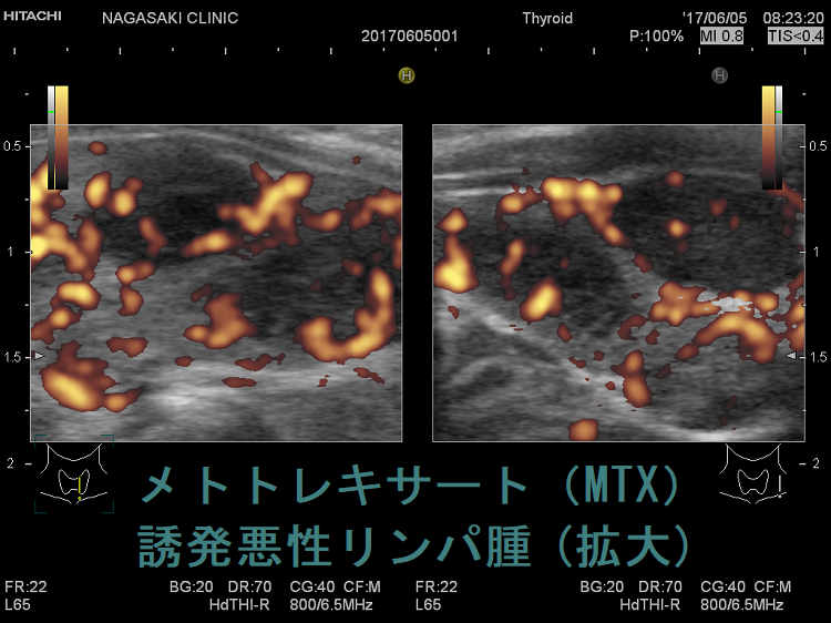 メトトレキサート(MTX)誘発悪性リンパ腫 超音波(エコー)画像 ドプラー(拡大) メトトレキサート(MTX)誘発悪性リンパ腫 超音波(エコー)画像 ドプラー(拡大)