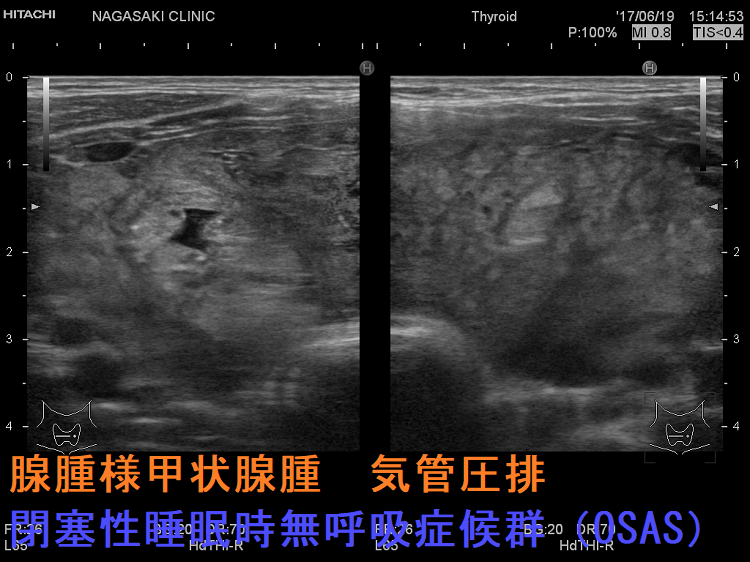 腺腫様甲状腺腫 気管圧排 閉塞性睡眠時無呼吸症候群(OSAS) 腺腫様甲状腺腫 気管圧排 閉塞性睡眠時無呼吸症候群(OSAS)