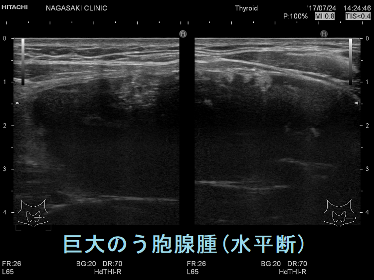 巨大のう胞腺腫 超音波(エコー)画像(水平断) 巨大のう胞腺腫 超音波(エコー)画像(水平断)
