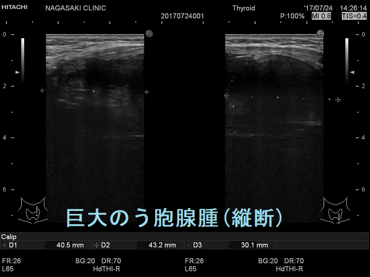 巨大のう胞腺腫 超音波(エコー)画像(縦断) 巨大のう胞腺腫 超音波(エコー)画像(縦断)