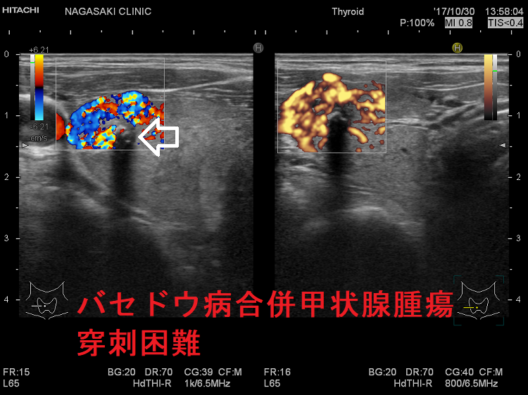 バセドウ病合併甲状腺腫瘍 穿刺困難 バセドウ病合併甲状腺腫瘍 穿刺困難