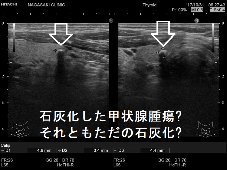 石灰化した甲状腺腫瘍?、それともただの石灰化? 石灰化した甲状腺腫瘍?、それともただの石灰化?