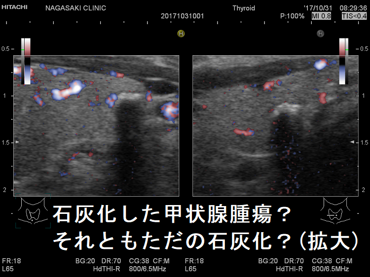石灰化した甲状腺腫瘍?、それともただの石灰化?(拡大) 石灰化した甲状腺腫瘍?、それともただの石灰化?(拡大)