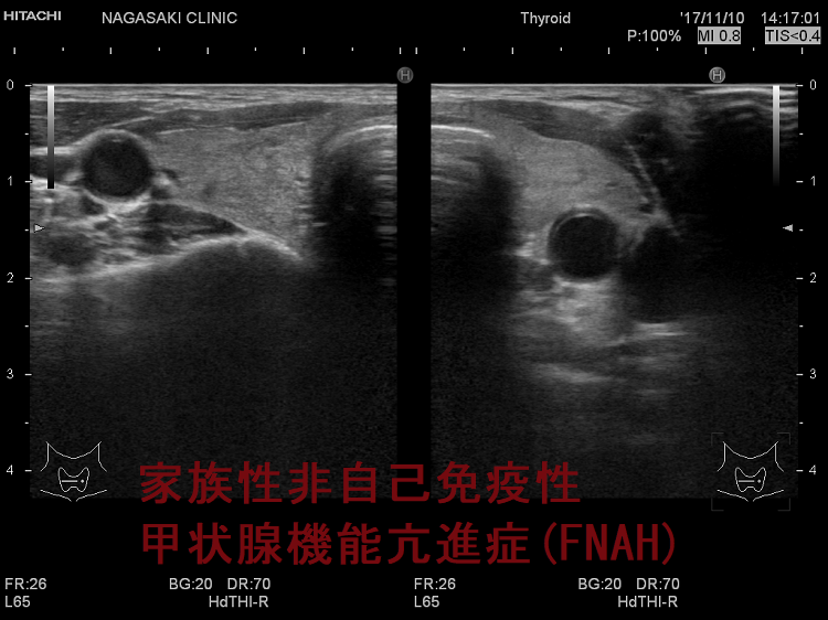 家族性非自己免疫性甲状腺機能亢進症(FNAH) 超音波(エコー)画像 家族性非自己免疫性甲状腺機能亢進症(FNAH) 超音波(エコー)画像