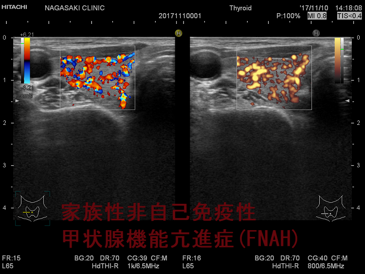 家族性非自己免疫性甲状腺機能亢進症(FNAH) ドプラー 家族性非自己免疫性甲状腺機能亢進症(FNAH) ドプラー
