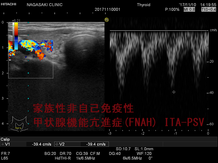 家族性非自己免疫性甲状腺機能亢進症(FNAH) ITA-PSV 家族性非自己免疫性甲状腺機能亢進症(FNAH) ITA-PSV