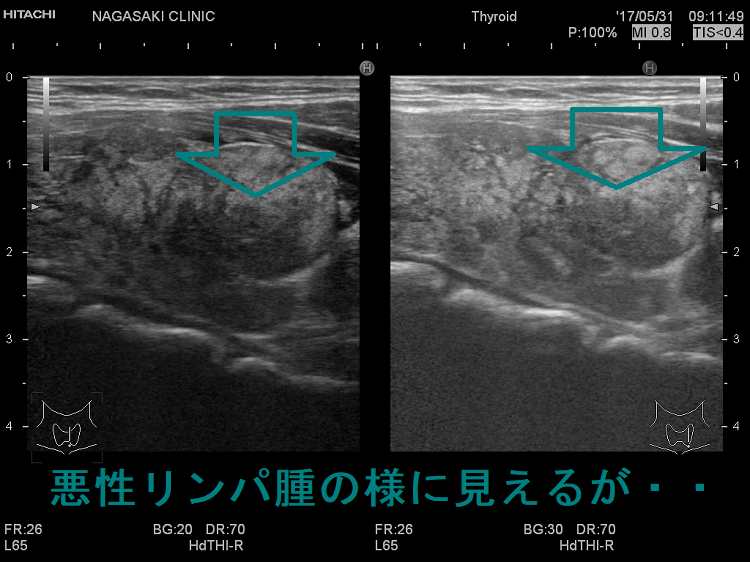 悪性リンパ腫の様に見えるが・・ 悪性リンパ腫の様に見えるが・・