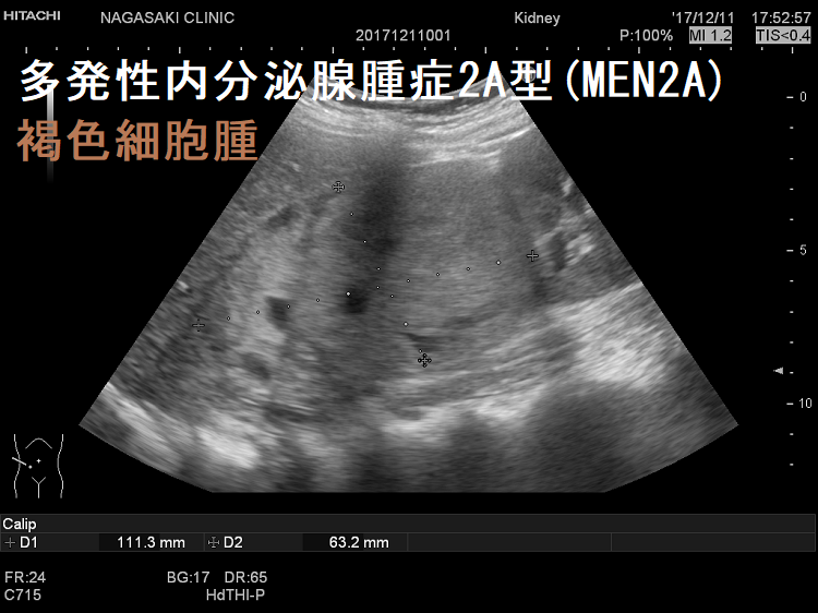多発性内分泌腺腫症2A型(MEN2A)褐色細胞腫 超音波(エコー)画像 多発性内分泌腺腫症2A型(MEN2A)褐色細胞腫 超音波(エコー)画像