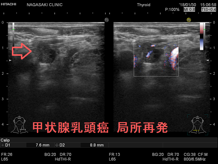 甲状腺乳頭癌局所再発 超音波(エコー)画像 甲状腺乳頭癌局所再発 超音波(エコー)画像