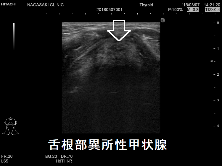 舌根部異所性甲状腺 超音波(エコー)画像 舌根部異所性甲状腺 超音波(エコー)画像