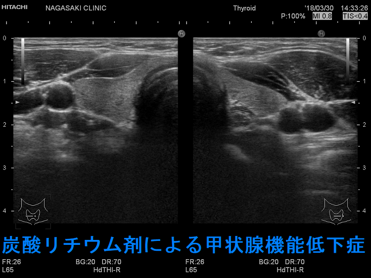 炭酸リチウム剤による甲状腺機能低下症 超音波(エコー)画像 炭酸リチウム剤による甲状腺機能低下症 超音波(エコー)画像