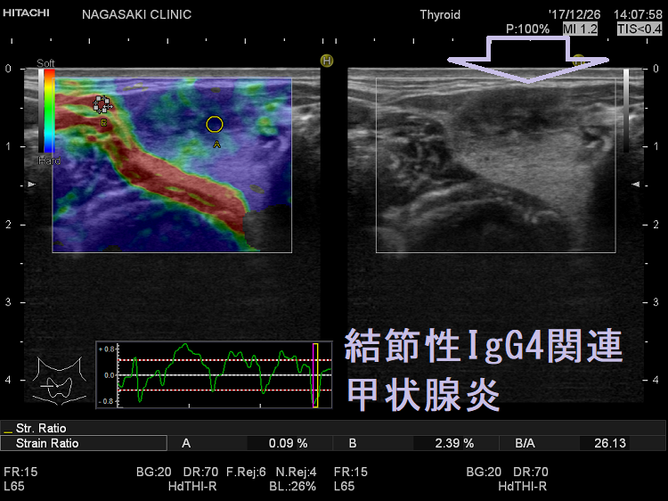 結節性IgG4関連甲状腺炎 超音波(エコー)画像 結節性IgG4関連甲状腺炎 超音波(エコー)画像