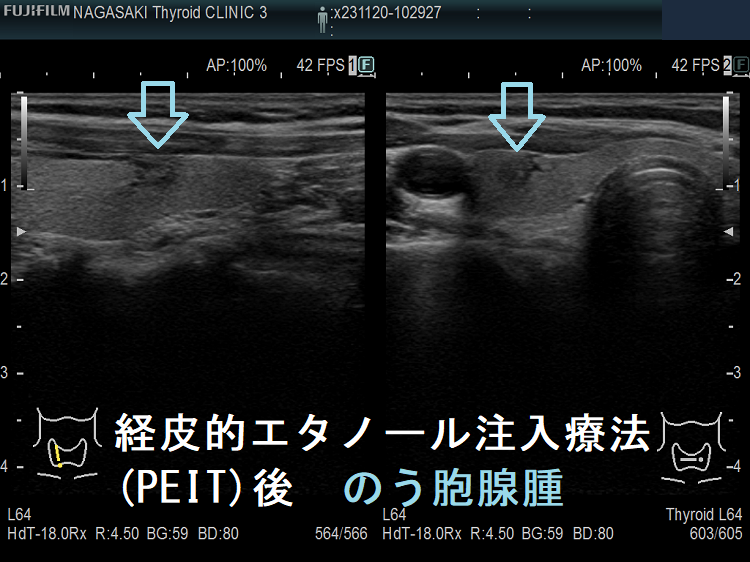 経皮的エタノール注入療法(PEIT)後 のう胞腺腫 経皮的エタノール注入療法(PEIT)後 のう胞腺腫