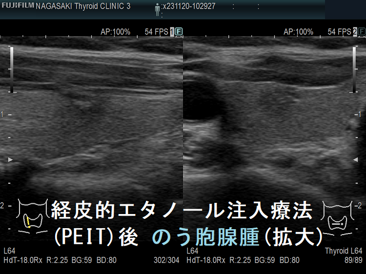 経皮的エタノール注入療法(PEIT)後 のう胞腺腫(拡大) 経皮的エタノール注入療法(PEIT)後 のう胞腺腫(拡大)