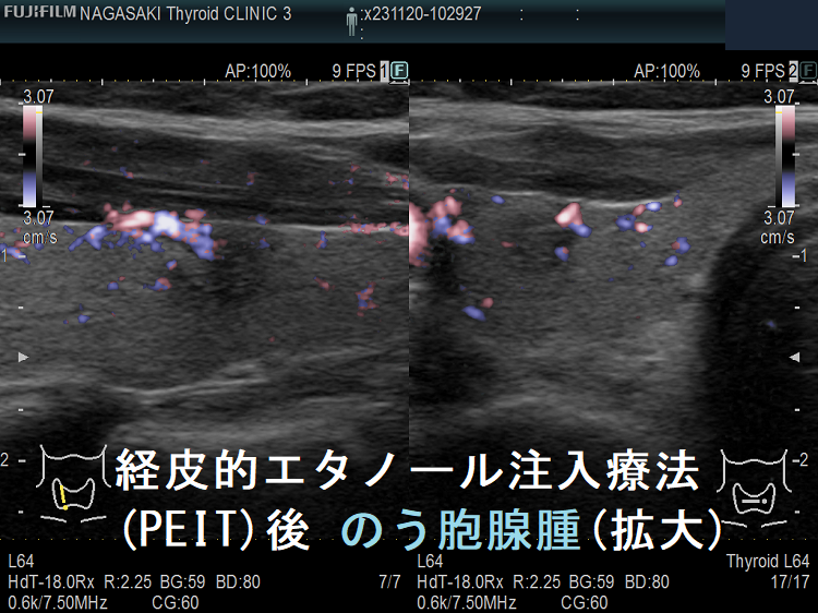 経皮的エタノール注入療法(PEIT)後 のう胞腺腫(拡大)ドプラーモード 経皮的エタノール注入療法(PEIT)後 のう胞腺腫(拡大)ドプラーモード