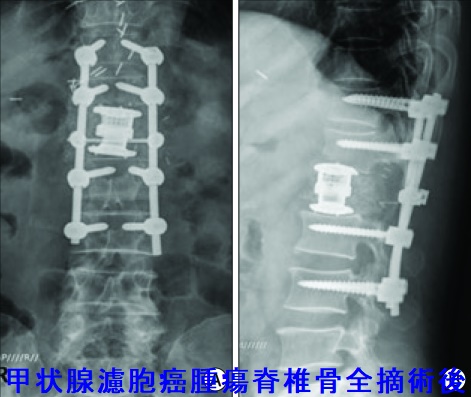 甲状腺濾胞癌 根治的腫瘍脊椎骨全摘術(TES)後 甲状腺濾胞癌 根治的腫瘍脊椎骨全摘術(TES)後
