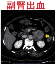 甲状腺乳頭癌の副腎転移、レンバチニブ誘発性腫瘍内出血 造影CT画像 甲状腺乳頭癌の副腎転移、レンバチニブ誘発性腫瘍内出血 造影CT画像