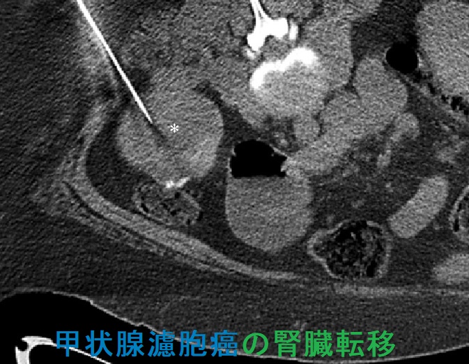 甲状腺濾胞癌の腎臓転移 CTガイド下生検 甲状腺濾胞癌の腎臓転移 CTガイド下生検