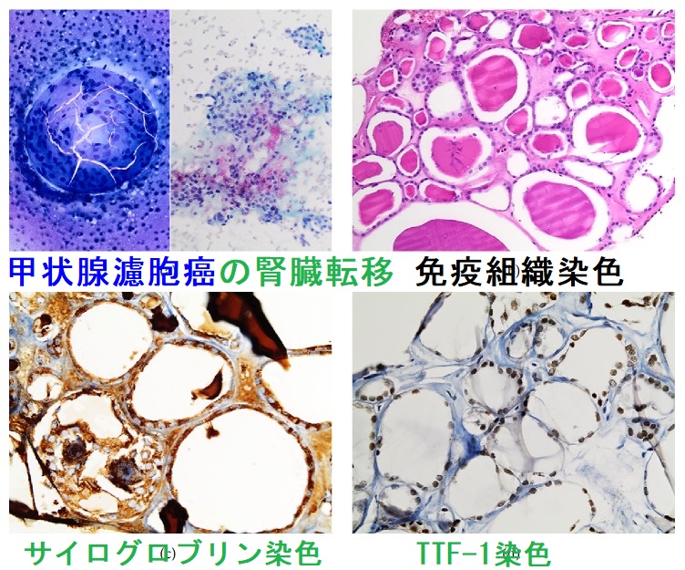 甲状腺濾胞癌の腎臓転移 免疫組織染色 甲状腺濾胞癌の腎臓転移 免疫組織染色