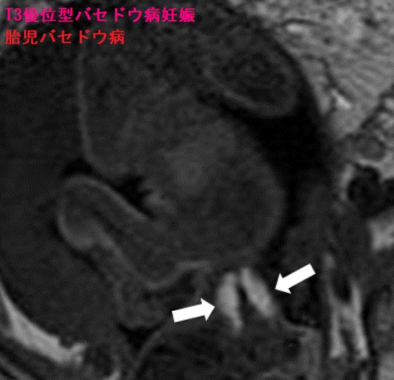 T3優位型バセドウ病妊娠 胎児バセドウ病 T3優位型バセドウ病妊娠 胎児バセドウ病