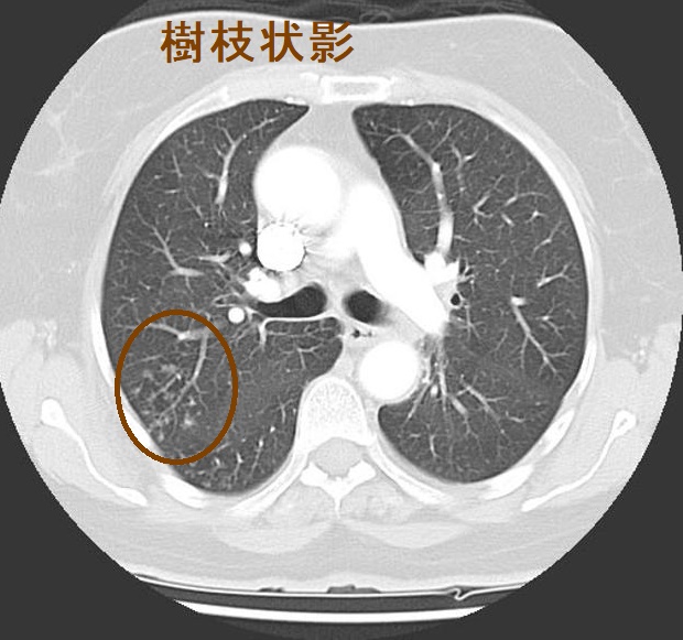 樹枝状影 樹枝状影