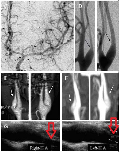 シャンパンボトルネック徴候 シャンパンボトルネック徴候