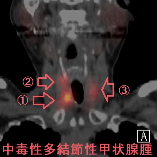 中毒性多結節性甲状腺腫 99mTCシンチグラフィー 中毒性多結節性甲状腺腫 99mTCシンチグラフィー