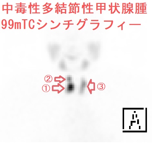 中毒性多結節性甲状腺腫 99mTCシンチグラフィー2 中毒性多結節性甲状腺腫 99mTCシンチグラフィー2