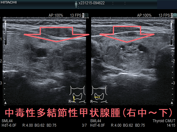 中毒性多結節性甲状腺腫(右中~下) 中毒性多結節性甲状腺腫(右中~下)