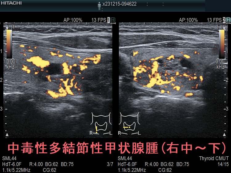 中毒性多結節性甲状腺腫(右中~下) ドプラーモード 中毒性多結節性甲状腺腫(右中~下) ドプラーモード