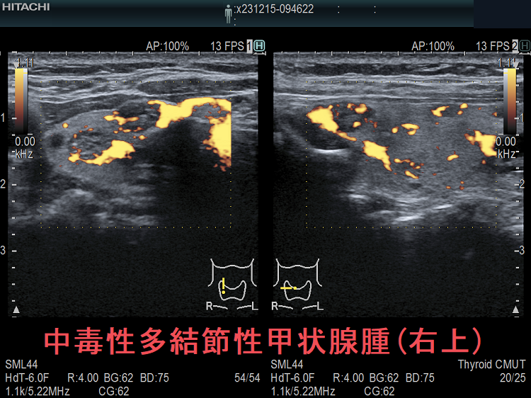 中毒性多結節性甲状腺腫(右上) ドプラーモード 中毒性多結節性甲状腺腫(右上) ドプラーモード