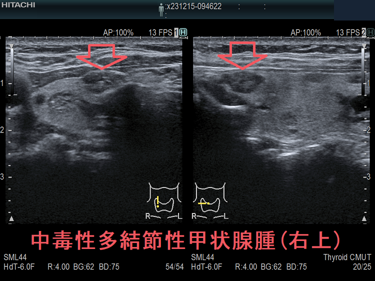 中毒性多結節性甲状腺腫(右上) 中毒性多結節性甲状腺腫(右上)