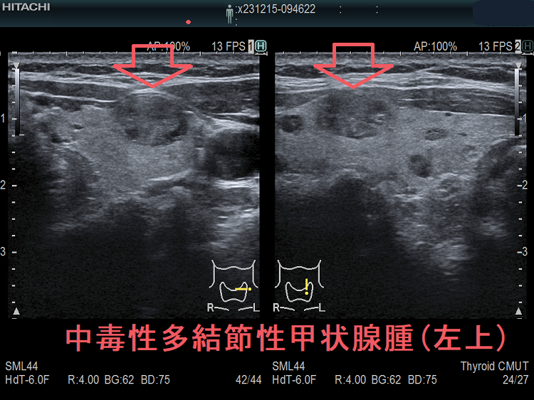 中毒性多結節性甲状腺腫(左上) 中毒性多結節性甲状腺腫(左上)