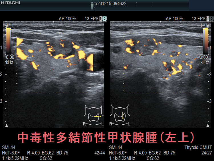 中毒性多結節性甲状腺腫(左上) ドプラーモード 中毒性多結節性甲状腺腫(左上) ドプラーモード