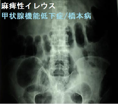 橋本脳症と偽性腸閉塞症(麻痺性イレウス)をおこした甲状腺機能低下症 橋本病患者 腹部単純レントゲン写真 橋本脳症と偽性腸閉塞症(麻痺性イレウス)をおこした甲状腺機能低下症 橋本病患者 腹部単純レントゲン写真