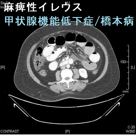橋本脳症と偽性腸閉塞症(麻痺性イレウス)をおこした甲状腺機能低下症 橋本病患者 腹部単純CT写真 橋本脳症と偽性腸閉塞症(麻痺性イレウス)をおこした甲状腺機能低下症 橋本病患者 腹部単純CT写真